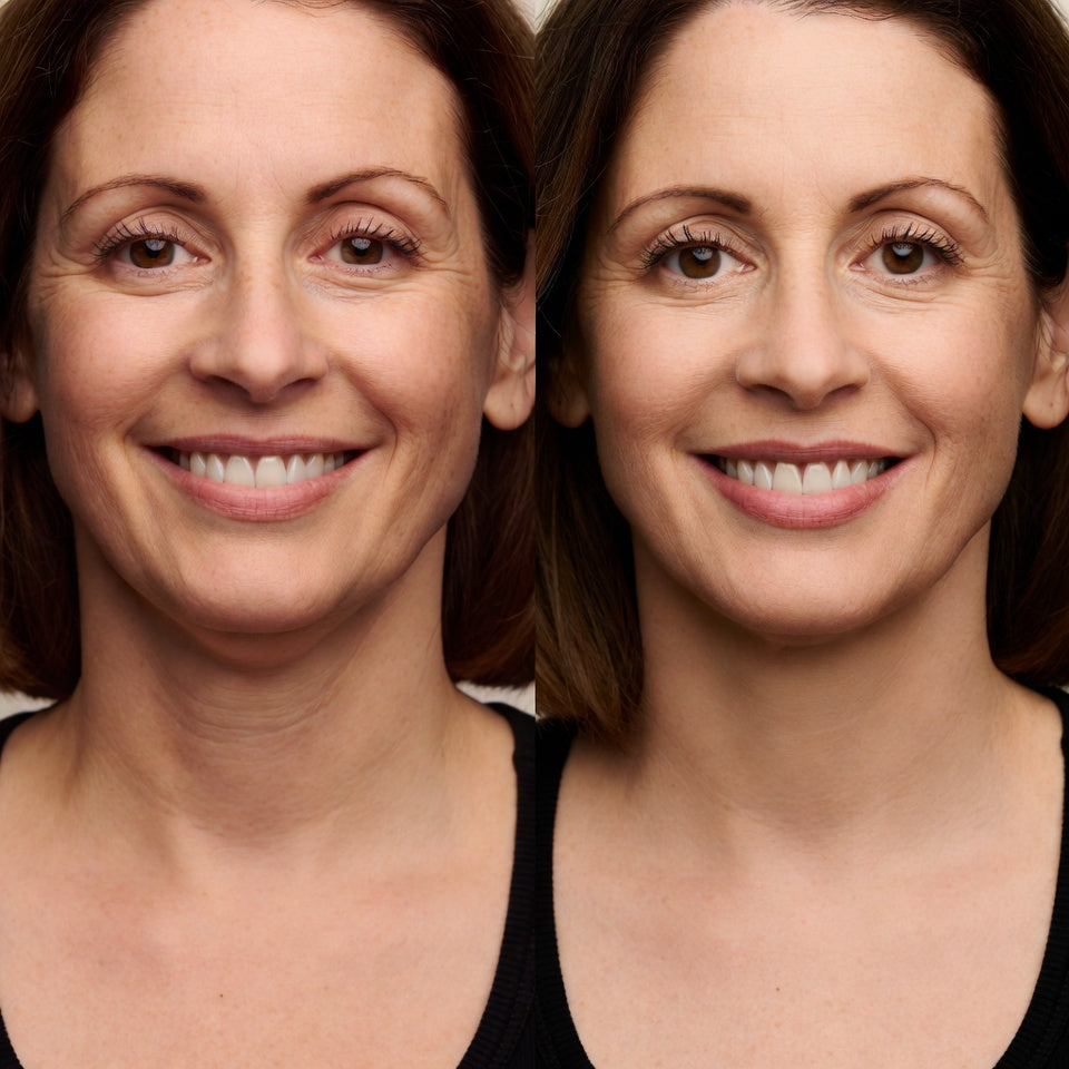 Double Chin Transformation